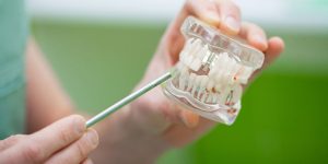 implant dentar