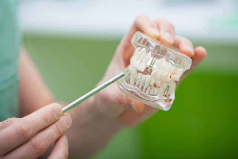 implant dentar